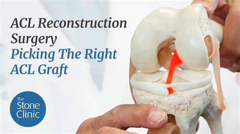 acl surgery greenwich|Best ACL Surgery Doctors in Greenwich, CT .